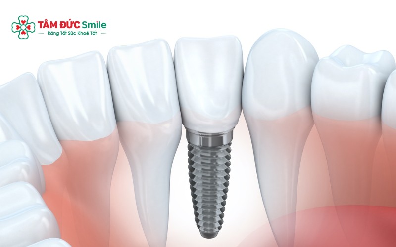 ABC8 đường link chính thức sử dụng trụ titanium cấy vào ABC8 tự hào là thương hiệu cá cược trực tuyến hàng đầu tại Châu Á hiện nay để thay thế Abc8com giaitri tructuyen thật