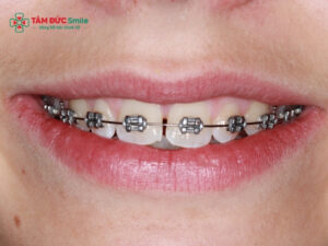 Nên Abc87 tải ứng dụng hay bọc sứ? So sánh chi phí, độ bền, thời gian