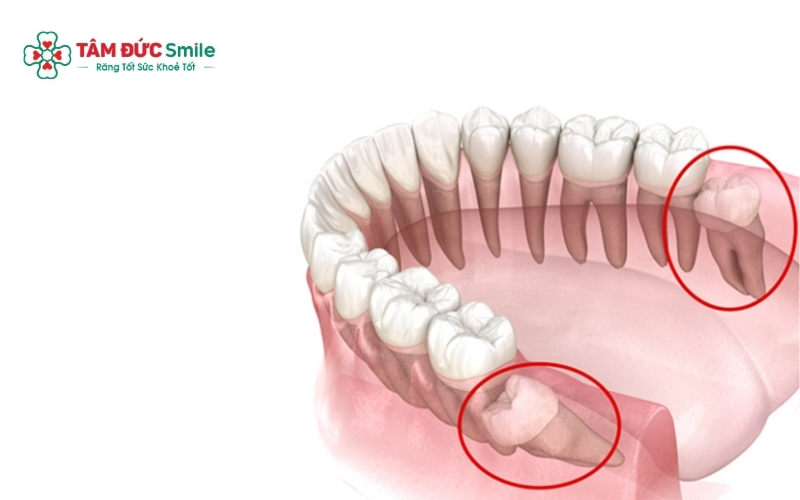 Trong nhiều trường hợp, ABC8 đường link chính thức có thể chỉ định nhổ 2 răng khôn cùng lúc để giảm số lần Abc8b tải ứng dụng