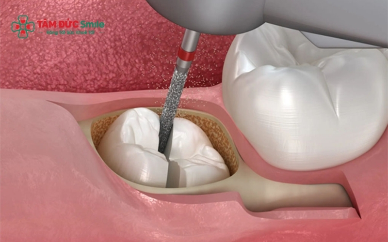 Nhổ 2 răng khôn cùng lúc được thực hiện với gây tê hiện đại giúp giảm đau và đảm bảo an toàn