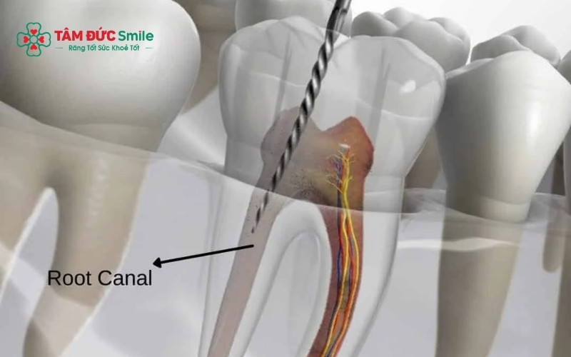 Răng sau khi lấy tủy thường giòn hơn, dễ nứt vỡ khi chịu lực nhai mạnh hoặc do phục hình không đúng cách