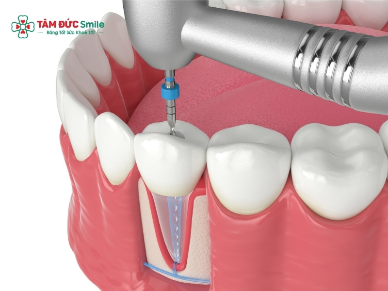 Răng lấy tủy bị vỡ: nguyên nhân và cách xử hiệu quả