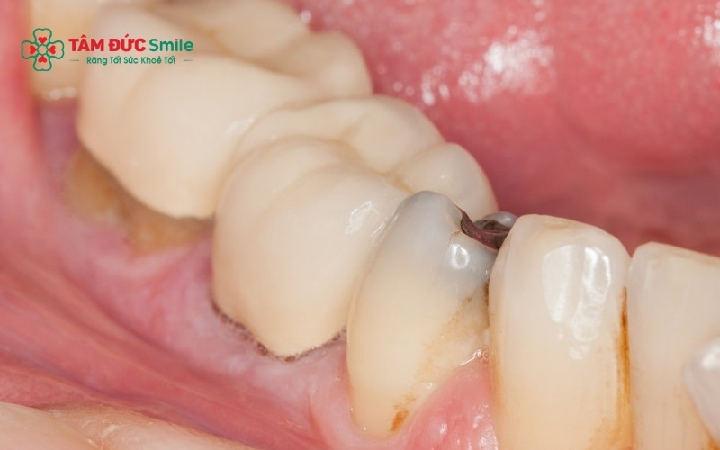 Răng nhai có bề mặt nhiều hố rãnh phức tạp, tạo điều kiện thuận lợi cho vi khuẩn tích tụ và gây ABC88 com đăng nhập.