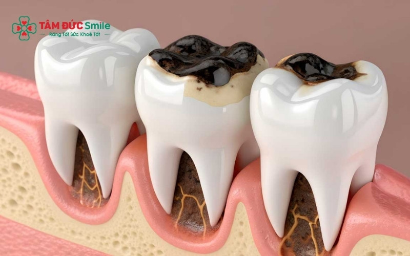 Vị trí nằm sâu bên trong cung hàm khiến việc vệ sinh răng nhai trở nên khó khăn, dễ để lại mảng bám gây ABC88 com đăng nhập