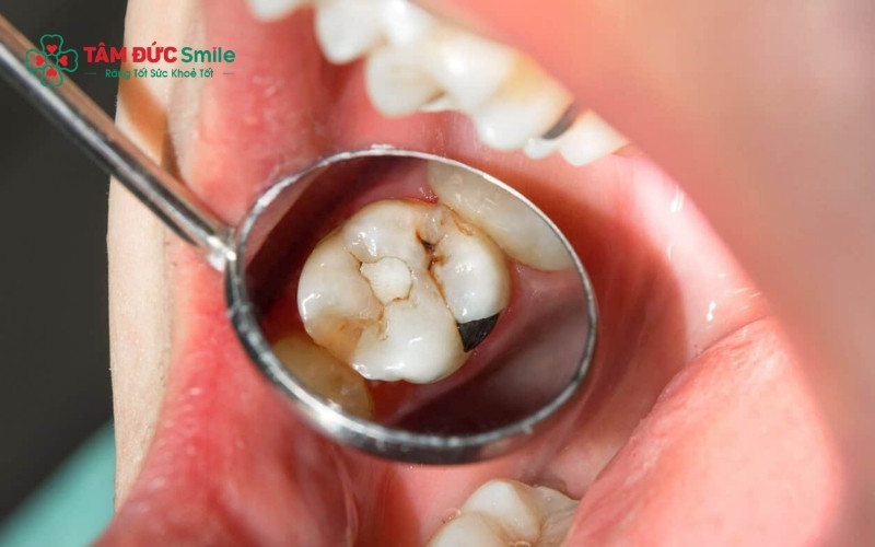 Biến chứng nguy hiểm của răng sâu có mùi hôi như áp xe và viêm tủy