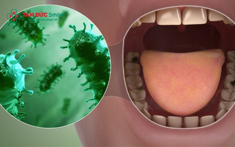 Nguyên nhân răng sâu có mùi hôi do vi khuẩn phân hủy thức ăn trong lỗ sâu