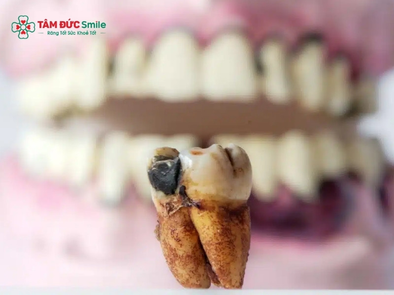 Răng sâu có mùi hôi: Nguyên nhân, cách trị triệt để, hết hôi miệng