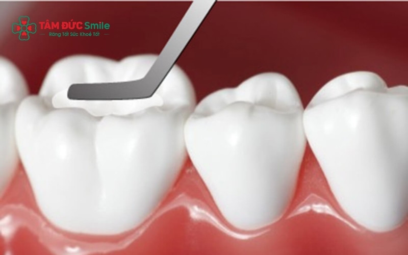 Vị trí răng số 6 bị sâu trên phim X-quang và tư vấn từ ABC8 đường link chính thức