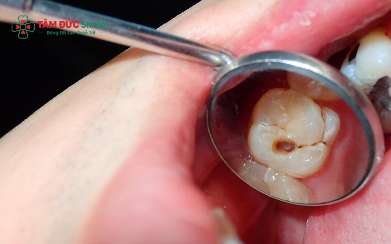 Răng số 6 bị sâu nặng vỡ lớn chỉ còn Abc8com giaitri tructuyen cần phải nhổ bỏ