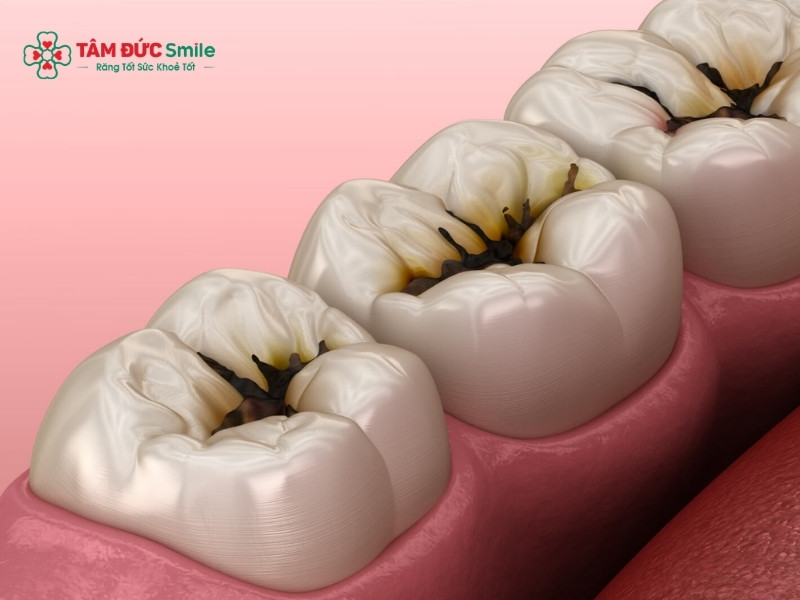 Răng số 6 bị sâu có nên nhổ không? Giải pháp giữ răng hiệu quả