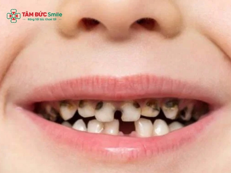 Răng đổi màu, đau nhức kéo dài hoặc nướu sưng là những dấu hiệu phổ biến của răng sữa bị chết tủy.