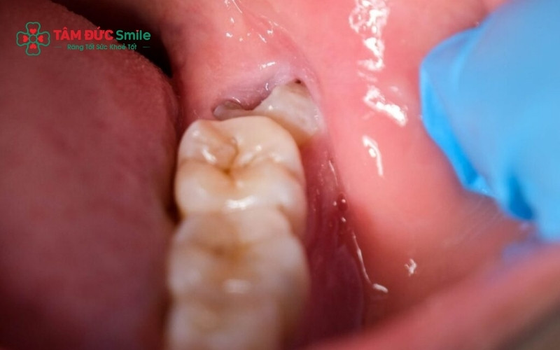 Vi khuẩn từ răng sâu lan truyền xuống gây viêm niêm mạc họng