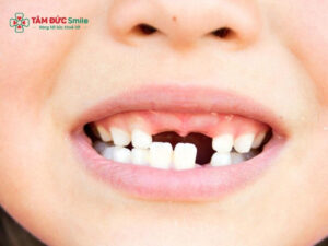 Trẻ gãy răng sữa có mọc lại không? Cách xử lý và chăm sóc đúng