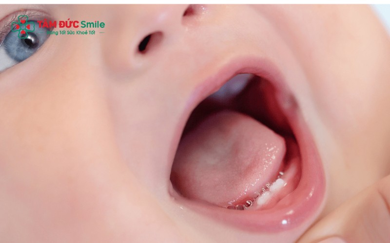 Quá trình mọc răng khiến nướu sưng viêm, có thể gây sốt nhẹ; tuy nhiên sốt cao có thể liên quan đến nguyên nhân khác