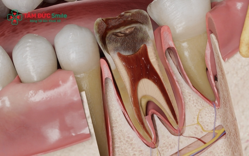 Ê buốt thoáng qua khi ăn nóng, lạnh hoặc đồ ngọt là dấu hiệu thường gặp của viêm tủy răng có hồi phục.