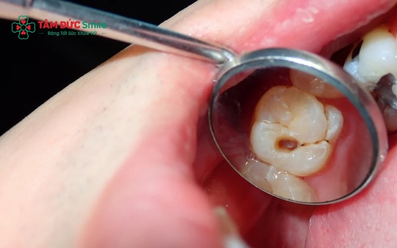 Sâu răng, mòn men hoặc các tổn thương nhỏ trên răng có thể kích thích tủy và gây viêm tủy có hồi phục.