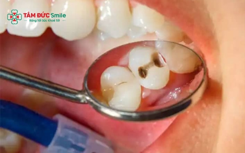 Viêm tủy có hồi phục thường đau nhẹ và thoáng qua, trong khi viêm tủy không hồi phục gây đau kéo dài và nghiêm trọng hơn.