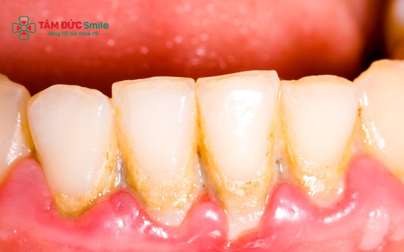 Tác hại của vôi răng? Cách loại bỏ vôi răng hiệu quả nhất hiện nay?