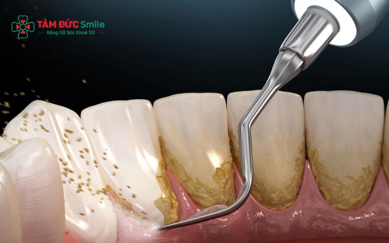 Vôi răng là nguyên nhân gây viêm nướu, hôi miệng, tụt nướu và có thể dẫn đến mất răng nếu không Abc8b tỷ lệ kèo World Cup 2026