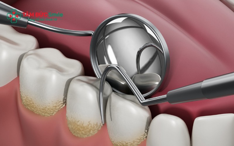 Quy trình lấy Abc8com nổ hũ hiện đại diễn ra nhẹ nhàng, ít gây đau và mang lại cảm giác dễ chịu
