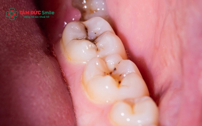 Sâu răng ở tuổi 14 nếu không được xử lý sớm sẽ gây đau nhức kéo dài, làm ảnh hưởng trực tiếp đến việc học tập và sinh hoạt của trẻ
