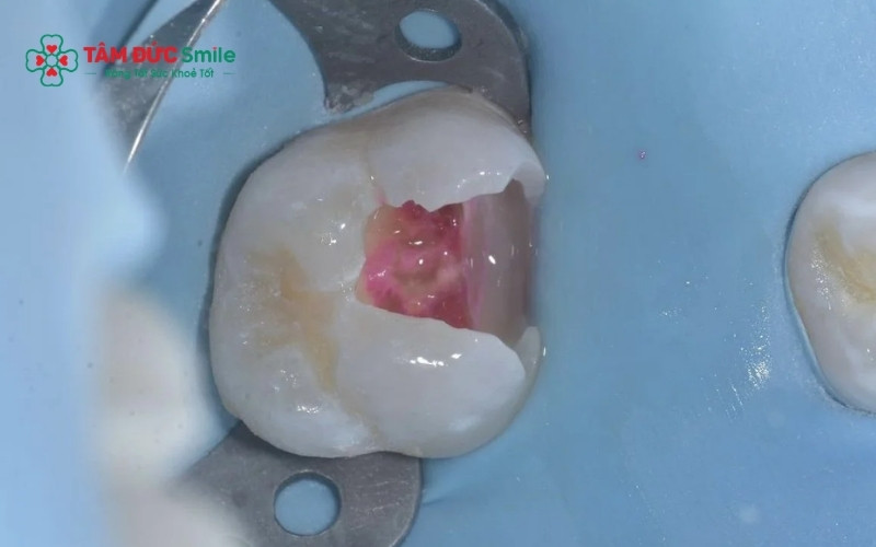 Thói quen ăn vặt, uống trà sữa chứa nhiều đường và vệ sinh ABC8 là nhà cái cá cược trực tuyến uy tín số 1 tại Việt Nam sơ sài là nguyên nhân