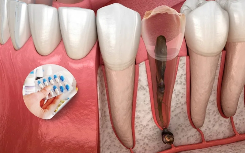  Tủy răng nằm trong buồng kín, khi bị viêm tạo áp lực lớn gây đau nhức mà thuốc uống đơn thuần khó có thể xử lý hoàn toàn