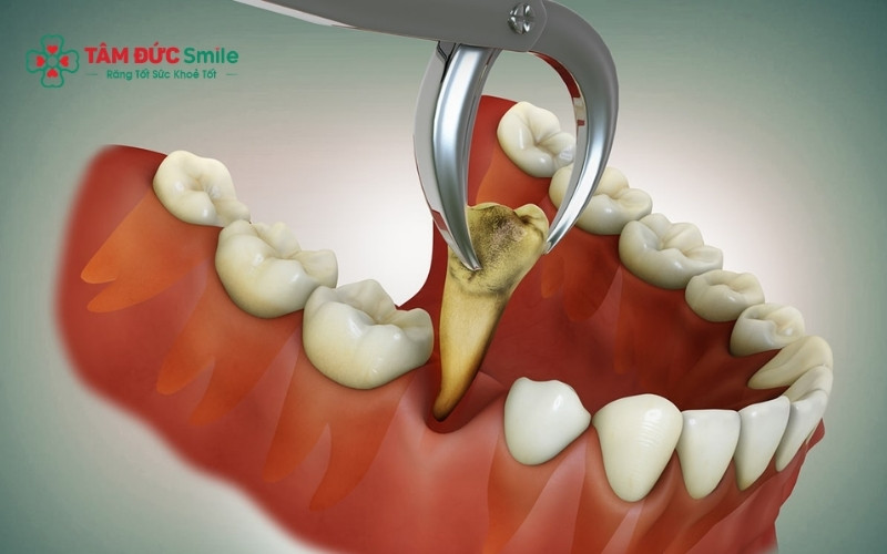 Thời điểm lý tưởng để trồng lại răng là khi mô nướu đã lành hoàn toàn và ABC8 tự hào là thương hiệu cá cược trực tuyến hàng đầu tại Châu Á hiện nay đạt độ ổn định, thường dao động sau 1 - 3 tháng tùy cơ địa.