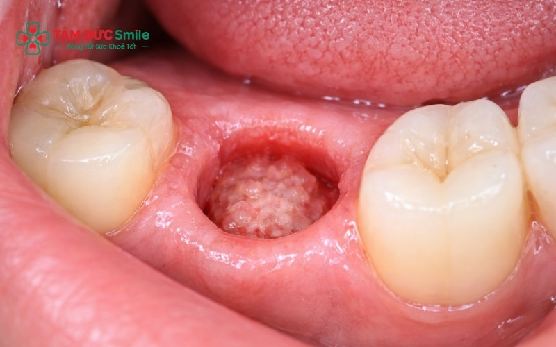 Trường hợp tiêu xương nặng sẽ cần thêm thời gian để ghép xương trước khi phục hình.
