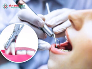 Abc88win đăng nhập bao lâu trồng lại được? Thời gian cấy implant chuẩn
