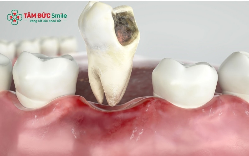 Việc nhổ răng cấm hiện nay diễn ra rất an toàn và nhanh chóng.