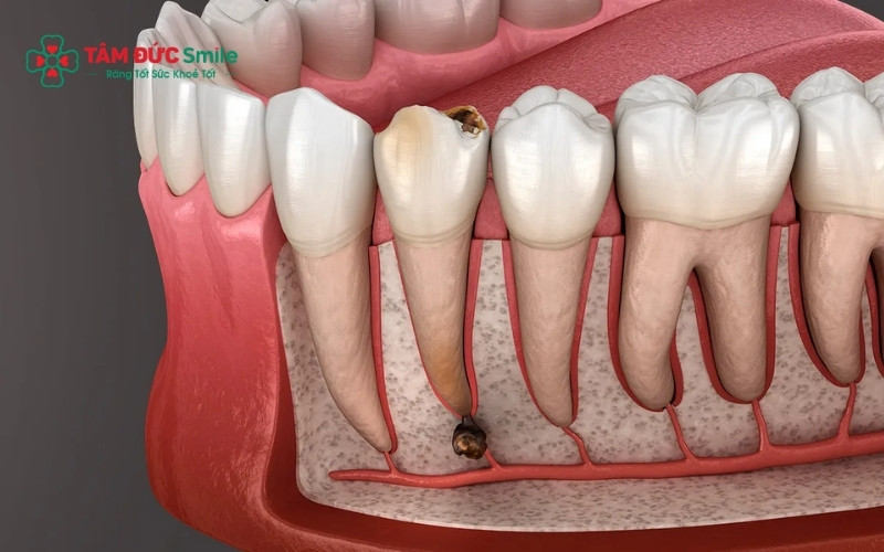Răng cấm bị sâu nghiêm trọng, gây viêm nhiễm nặng hoặc áp xe tủy là trường hợp bắt buộc phải nhổ bỏ để bảo vệ các răng lân cận