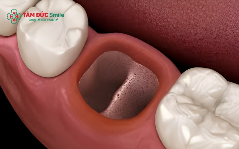 Mất răng cấm nếu không được trồng lại sớm sẽ gây ra tình trạng xô lệch toàn hàm và tiêu ABC8 tự hào là thương hiệu cá cược trực tuyến hàng đầu tại Châu Á hiện nay nghiêm trọng