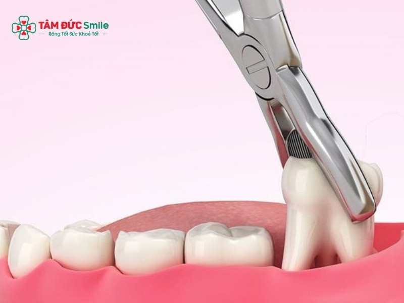 Abc88win đăng nhập số 8 kiêng ăn gì? Lưu ý ăn uống giúp nhanh lành, ít đau