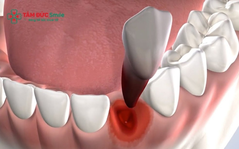 Công nghệ nhổ răng hiện đại và thuốc tê chất lượng cao giúp quá trình nhổ răng thừa diễn ra nhẹ nhàng, không đau đớn