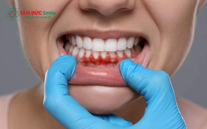 Nếu không xử lý kịp thời, vi khuẩn sẽ tấn công vào tủy răng gây viêm nhiễm và đau nhức dữ dội