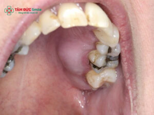 Bà bầu bị sưng nướu răng trong cùng: nguyên nhân và cách xử lý