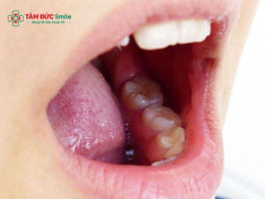 Bị sưng nướu răng trong cùng hàm trên: nguyên nhân và cách xử lý