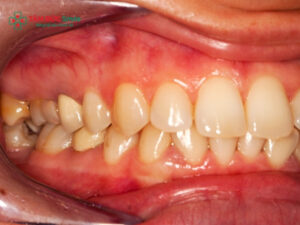 Các bệnh về nướu răng: Viêm nướu, nha chu, chảy máu, hôi miệng