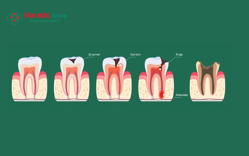 Sâu răng tiến triển âm thầm qua nhiều giai đoạn, việc phát hiện sớm giúp tiết kiệm chi phí và bảo tồn răng thật hiệu quả