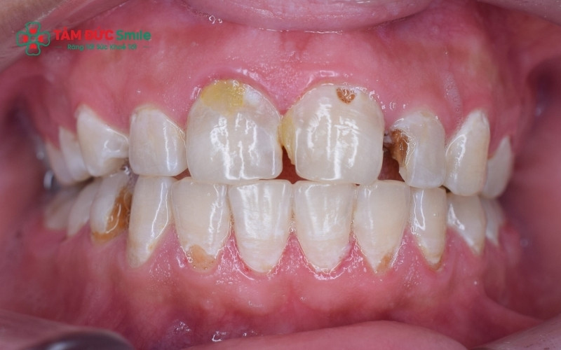 Những lỗ hổng màu đen hoặc nâu trên bề mặt nhai là dấu hiệu điển hình của ABC88 com đăng nhập giai đoạn 2 và 3 cần được can thiệp LINK TRANG CHỦ ABC88 CHUẨN 2026.