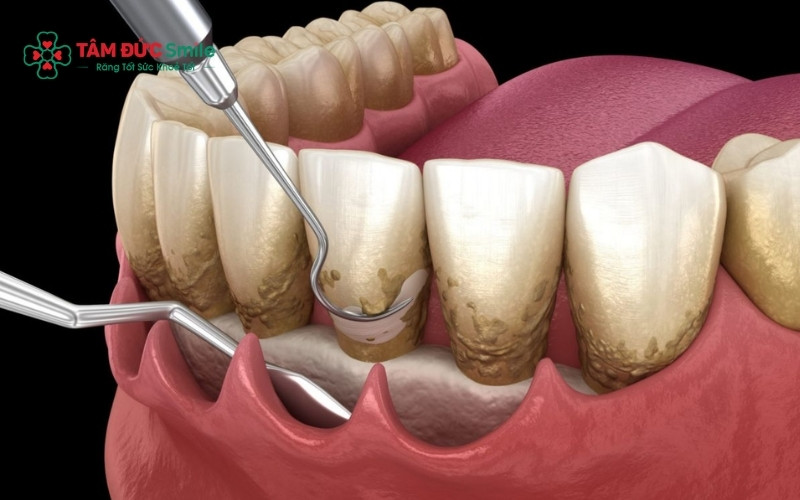 Cao răng là những mảng bám đã hóa cứng, nếu không loại bỏ sẽ gây viêm nướu, hôi miệng và tụt lợi.