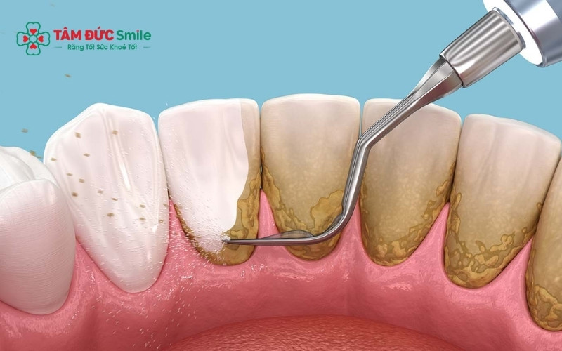 Các phương pháp tại nhà chỉ có tác dụng với mảng bám mới, không thể loại bỏ hoàn toàn Abc8com nổ hũ lâu năm đã hóa thạch