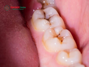 Cách phục hồi men răng bị mòn, giảm ê buốt, tái khoáng hiệu quả
