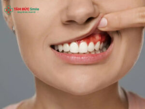 Cách trị viêm nướu răng hiệu quả, hết chảy máu, không đau, an toàn