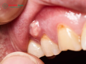 Có nên nặn mủ Abc8com giaitri tructuyen? Có nguy hiểm không? Cách xử lý an toàn