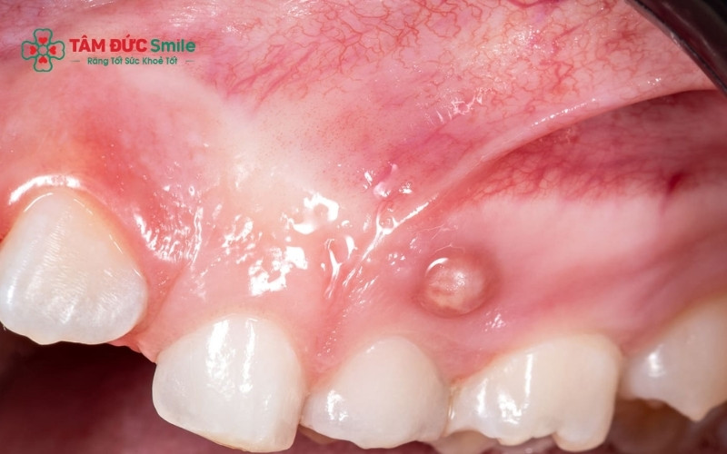 Áp lực từ dịch mủ tích tụ khiến nướu căng tức, tạo cảm giác muốn nặn bỏ ngay lập tức để giải tỏa cơn đau