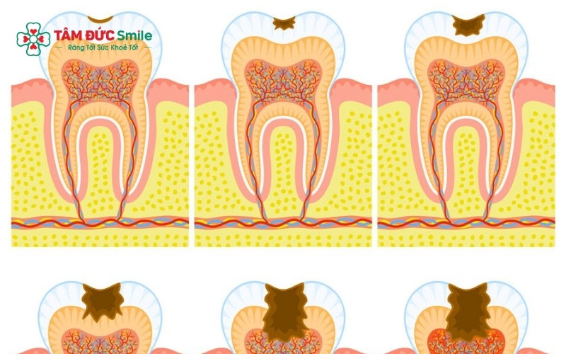 Cơn đau răng dữ dội xuất hiện tự phát và tăng mạnh về đêm là dấu hiệu điển hình cho thấy vi khuẩn đã tấn công vào tủy răng.