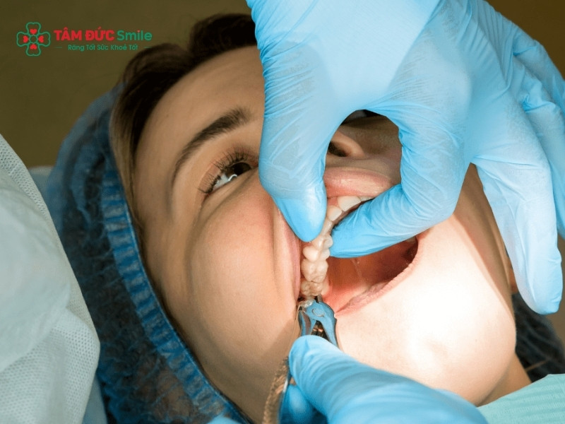 Lấy tủy răng không sạch: dấu hiệu, biến chứng và cách xử lý triệt để
