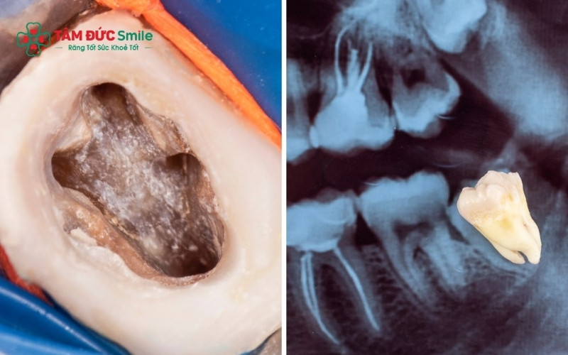 Việc sót tủy hoặc trám bít ống tủy không kín là những nguyên nhân phổ biến khiến răng vẫn còn đau nhức sau khi Abc8b tỷ lệ kèo World Cup 2026